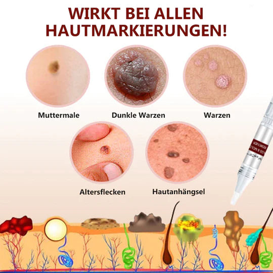 MoleFix™ Hautanhängsel & Maulwurfsentferner (1+1 GRATIS)