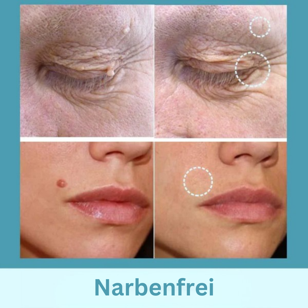 DermaFix™ Pflaster zur Entfernung von Hautmarkierungen