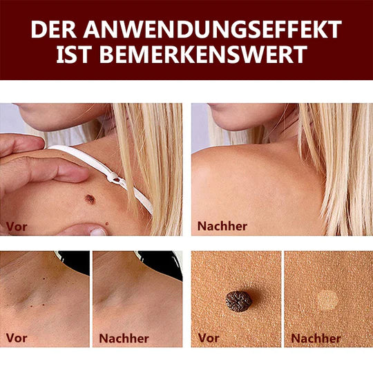 MoleFix™ Hautanhängsel & Maulwurfsentferner (1+1 GRATIS)