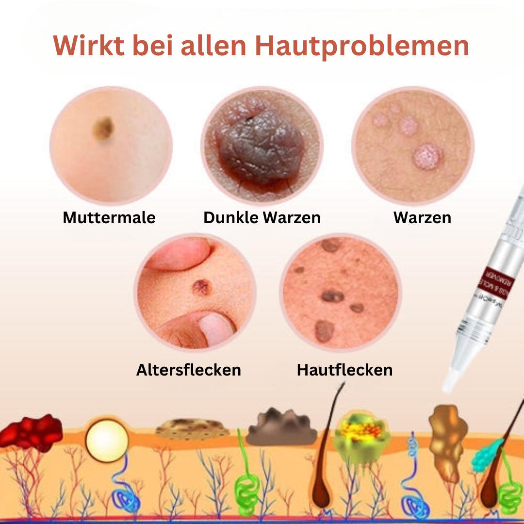 WipeOff™ Hautanhängsel & Maulwurfsentferner (1+1 GRATIS)